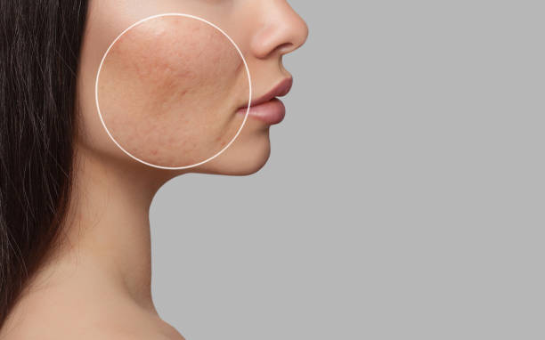 best doctor for acne acne scar pigmentation & melasma treatment in panvel navi mumbai.jpg